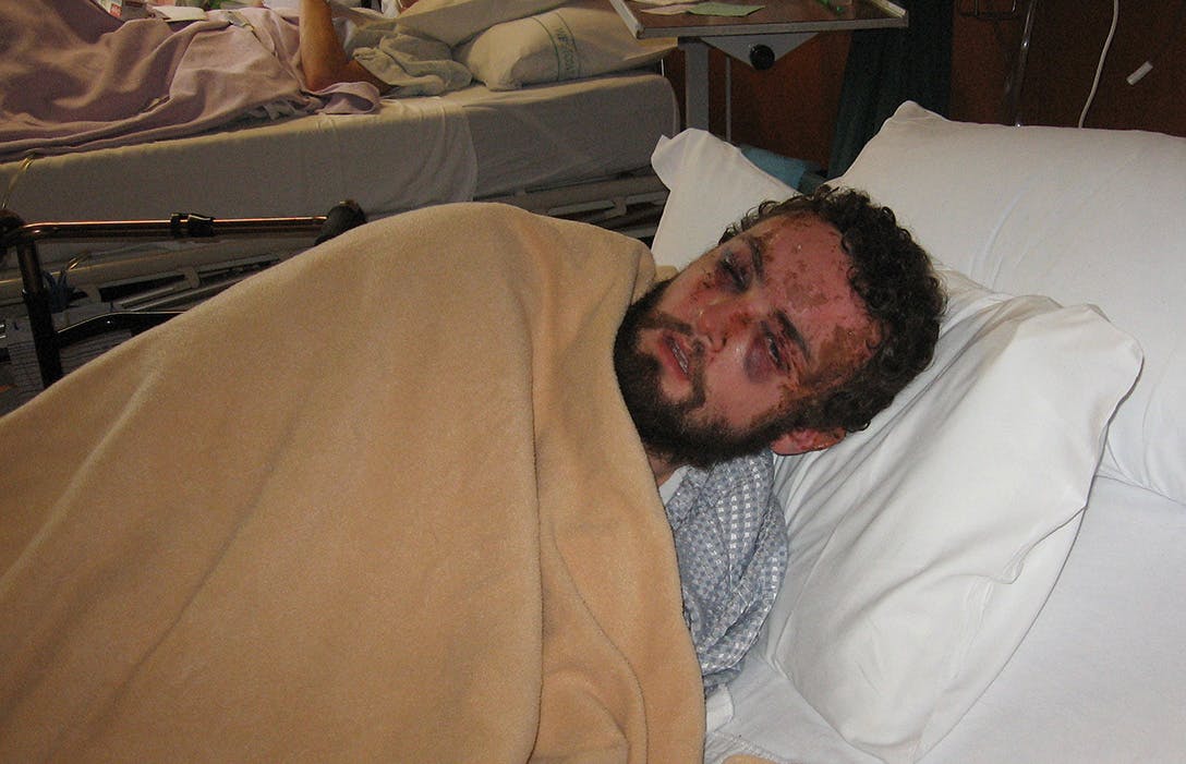 Nelson suffered concussion, three broken wristbones and frostbite to his feet as a result of the accident. Photo: Supplied