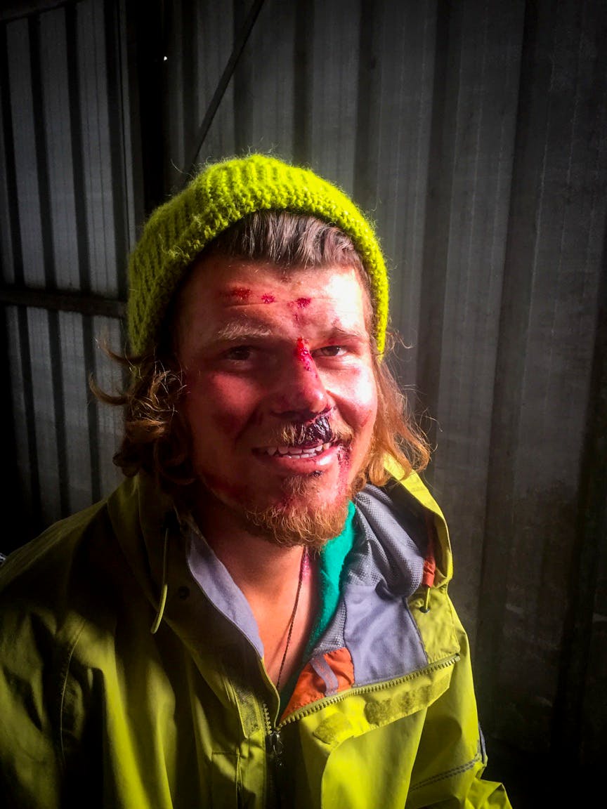 Jamie Hareb suffered a broken femur and ankle, as well as bruising and lacerations. Photo: Supplied